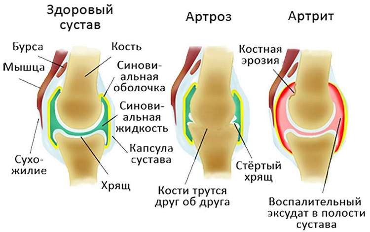 Отличия между артритом и артрозом