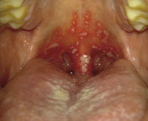 Проявление герпетического стоматита в горле
