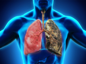 хроническая обструктивная болезнь лёгких