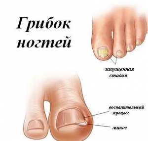 грибок ногтя