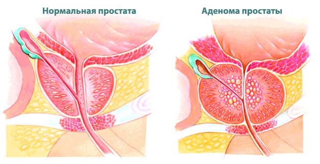 гиперплазия предстательной железы