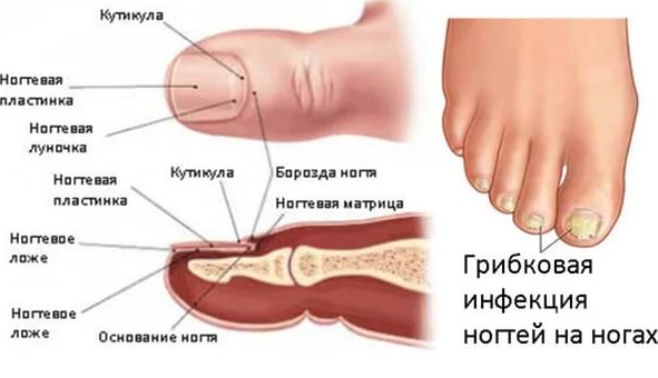 грибок ногтей на ногах