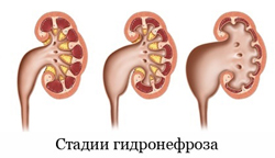 3 стадии гидронефроза наглядно