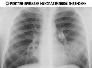 микоплазменная пневмония на рентгене