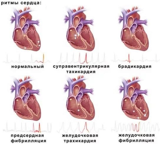 Симптомы аритмии сердца: признаки нарушения сердечного ритма