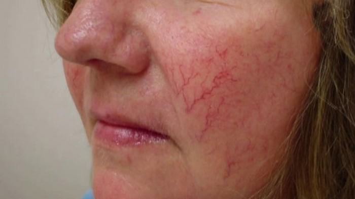 Лечение купероза на лице: симптомы, причины и способы лечения