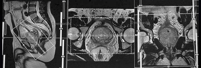 магниторезонансная томография предстательной железы