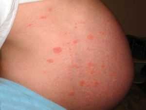 Аллергия у беременных