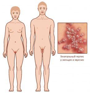 Симптомы генитального (второго типа) герпеса