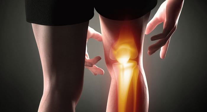Признаки и лечение артрита коленного сустава