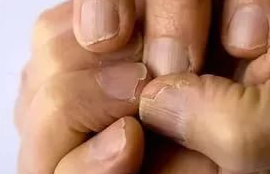 грибок ногтей на руках