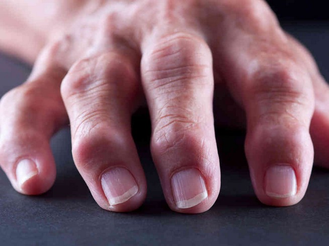 Причины и способы лечения артрита пальцев рук