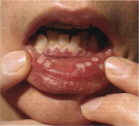 Стоматит на внутренней губе