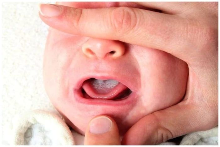 Молочница у ребенка: симптомы, причины и лечение