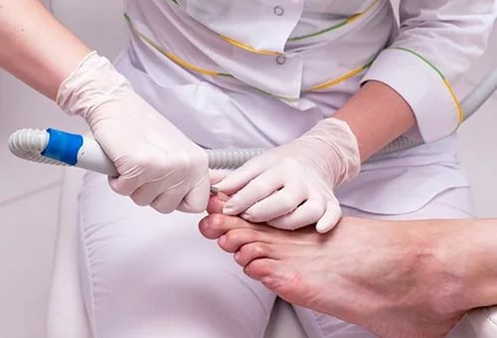Как лечить вросший ноготь на большом пальце ноги в домашних условиях