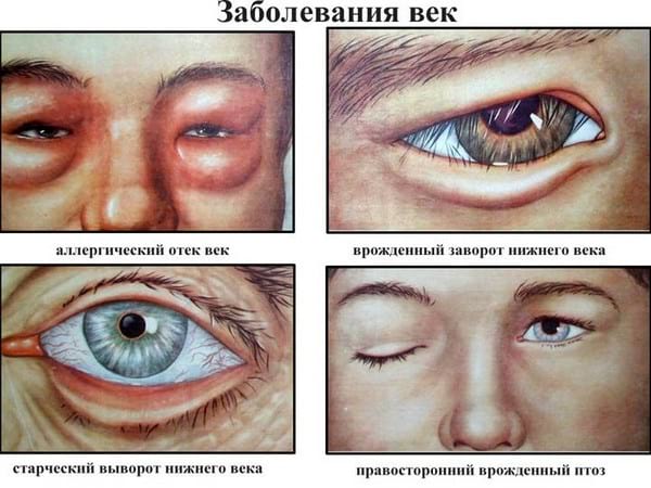 Болезни глаз у человека список заболеваний