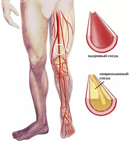 Атеросклероз нижних конечностей: причины развития