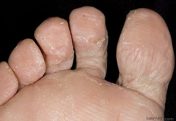 Грибок между пальцами ног
