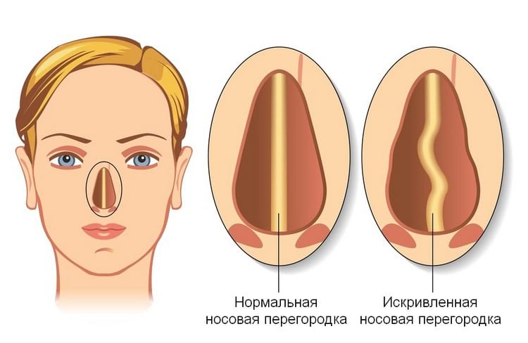 Как исправить искривление перегородки носа