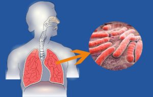 туберкулез легких