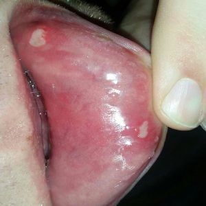 Как выглядит стоматит на губе