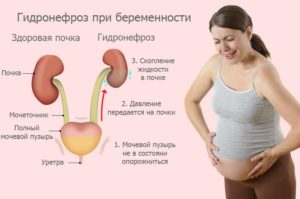 гидронефроз при беременности схема